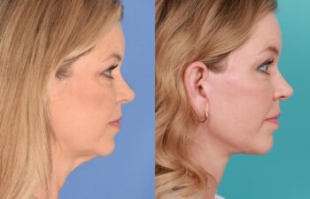 54 YR - 8 Months Postop: Endoscopic Browlift + Lower Blepharoplasty + Facelift + Buccal Fat Reduction + Fat Grafting + Laser