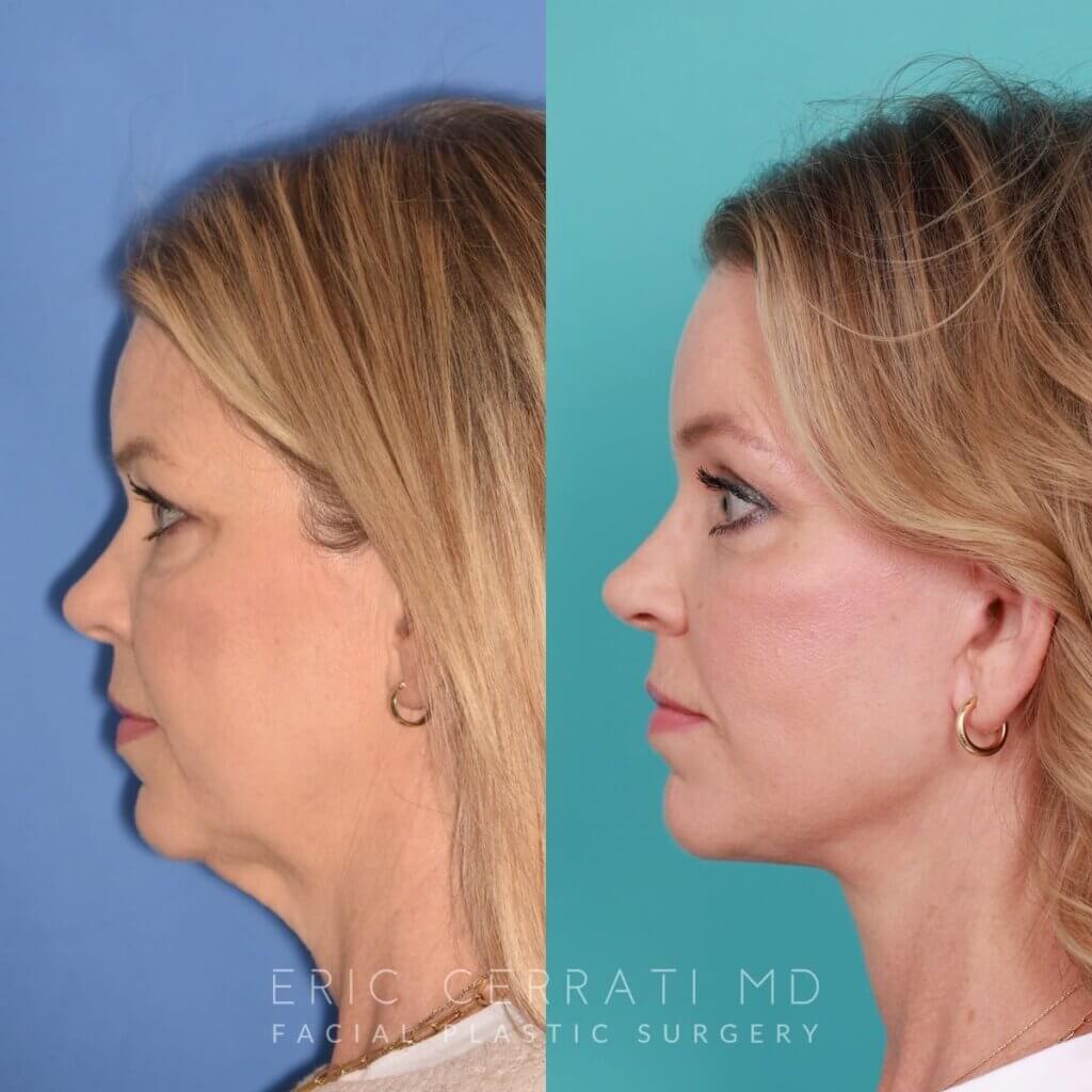 54 YR - 8 Months Postop: Endoscopic Browlift + Lower Blepharoplasty + Facelift + Buccal Fat Reduction + Fat Grafting + Laser