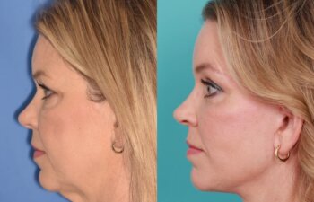54 YR - 8 Months Postop: Endoscopic Browlift + Lower Blepharoplasty + Facelift + Buccal Fat Reduction + Fat Grafting + Laser